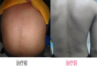 牛皮癣前期有什么症状