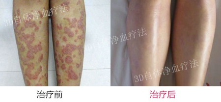 正确治疗牛皮癣该怎样做