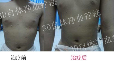 小儿牛皮癣早期症状