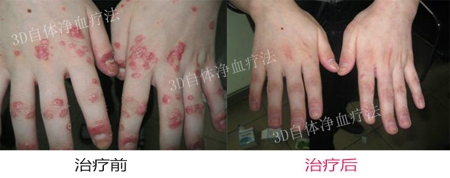 关节型牛皮癣怎么护理