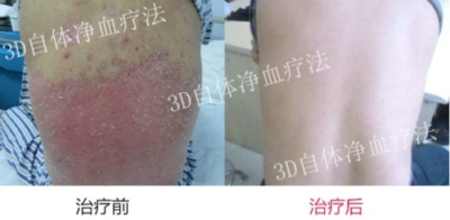 银屑病发病原因是什么