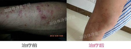 头部银屑病怎么治疗