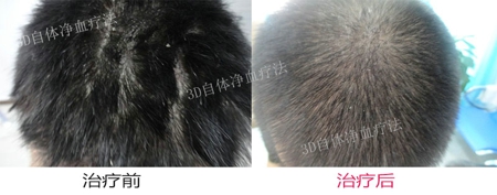 头部牛皮癣洗头要注意什么