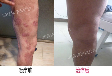 为什么会患上银屑病