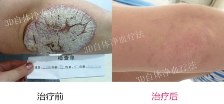 牛皮癣会给患者带来哪些危害
