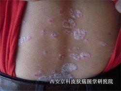 治疗牛皮癣要注意哪些问题