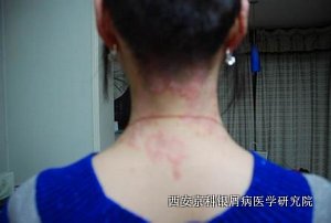 牛皮癣患者饮食要注意哪些问题