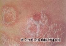 牛皮癣外用药治疗注意什么