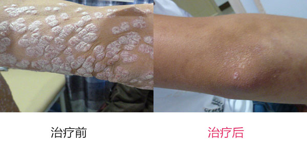 牛皮癣治疗怎么做