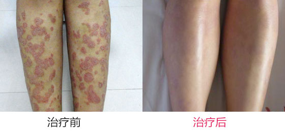 牛皮癣治疗有要注意哪些