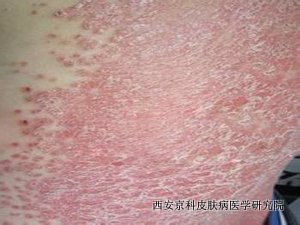 牛皮癣的症状有哪些