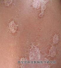 牛皮癣怎么治
