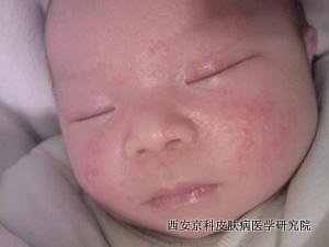 婴儿牛皮癣的症状有哪些