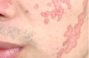 脸上出现脸上出现银屑病怎么办银屑病怎么办