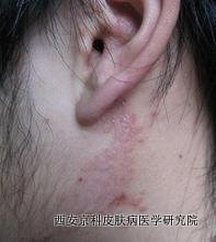 身上有银屑病怎么治疗