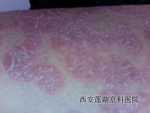 牛皮癣患者怎么科学饮食