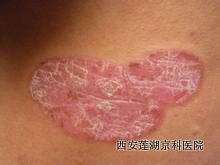 牛皮癣怎么预防