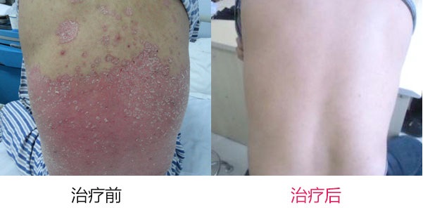 如何治疗牛皮癣