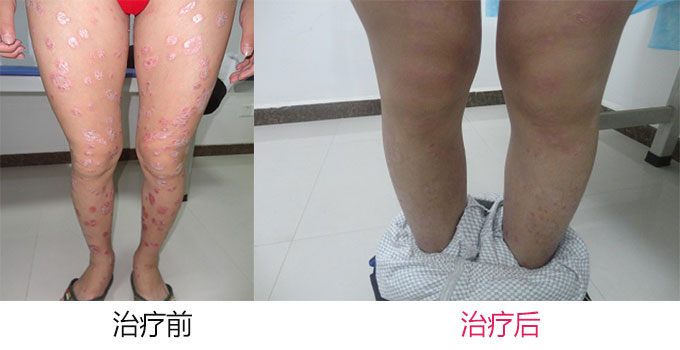 牛皮癣如何根治