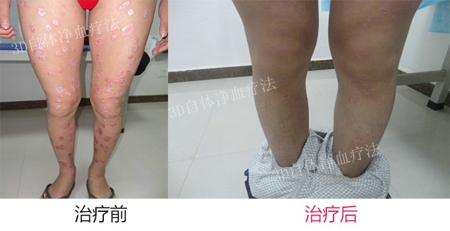 牛皮癣怎么治疗好