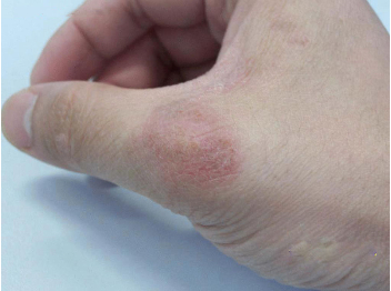 引起牛皮癣的病因是什么
