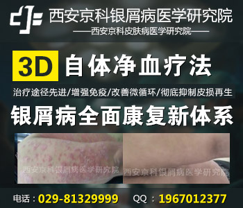西安治疗牛皮癣最好的医院