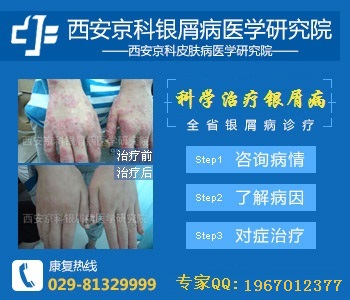 西安哪个医院治牛皮癣好
