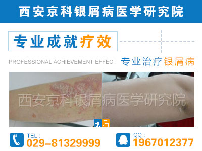 郑州哪个医院看银屑病权威