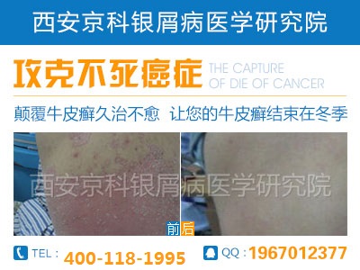 甘肃有治疗牛皮癣的吗