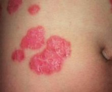 '牛皮癣有哪些护理要点'